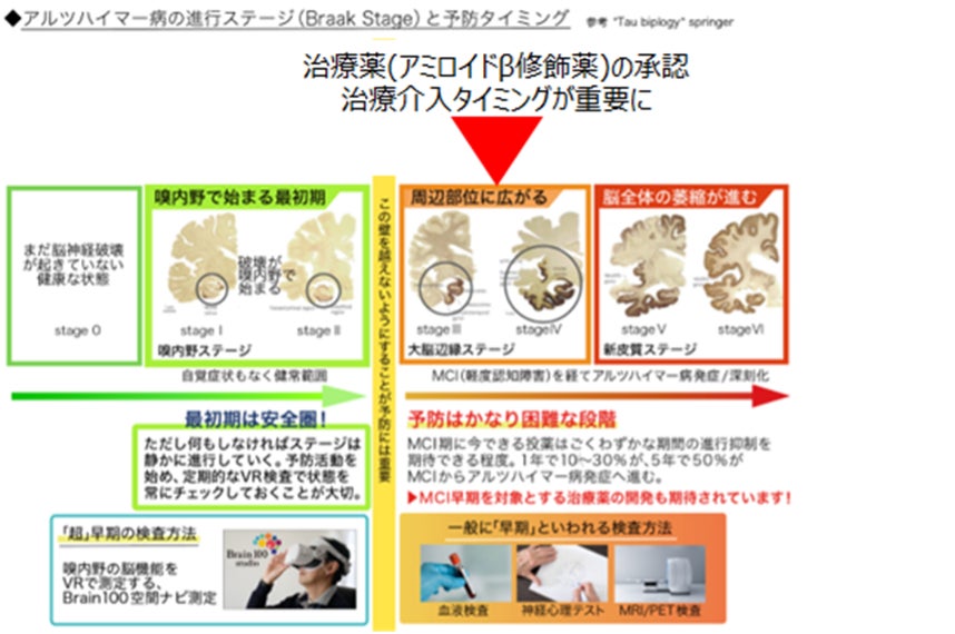 「アルツハイマー病の発症前の脳の異常を検出する方法を開発」国際学術誌に論文が掲載、MIGの脳健康VR測定