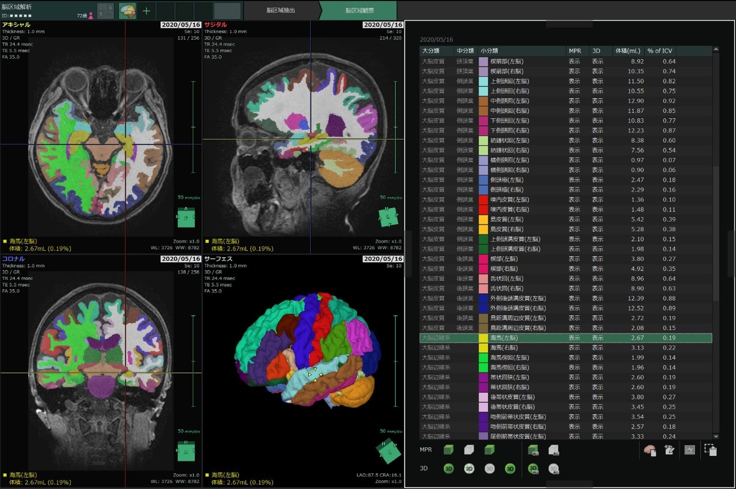 AI（人工知能）を用いた脳容積解析ソフトウェアを開発