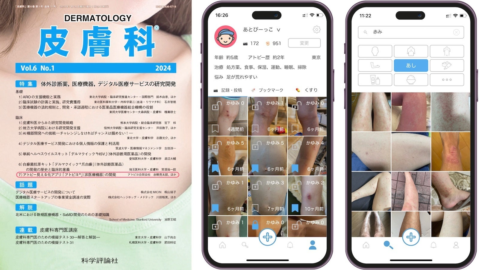 日本最大級のアトピー患者向けアプリ「アトピヨ」が権威ある皮膚科専門誌「皮膚科」7月号に掲載！ 〜デジタル...