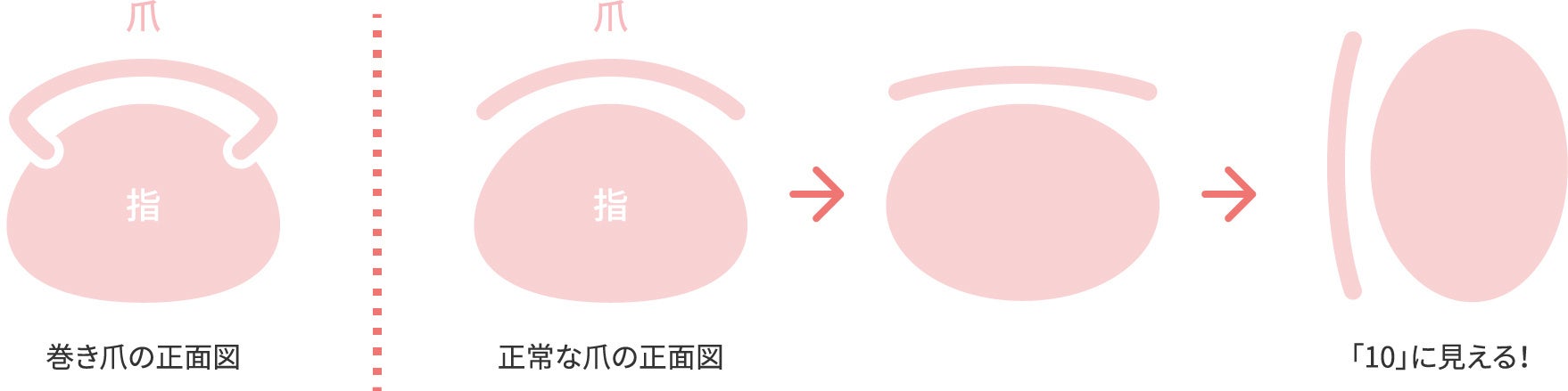 【巻き爪・巻き爪治療に関する調査】7月10日は「巻き爪を知る！治す！予防する！日」巻き爪に悩む人で医療機...