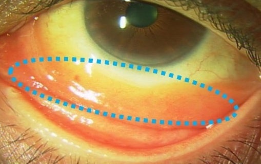 鮭の切り身のような赤さを持った結膜下方のリンパ腫の病変。びまん性に広がっているので完全に切除するのは難しい