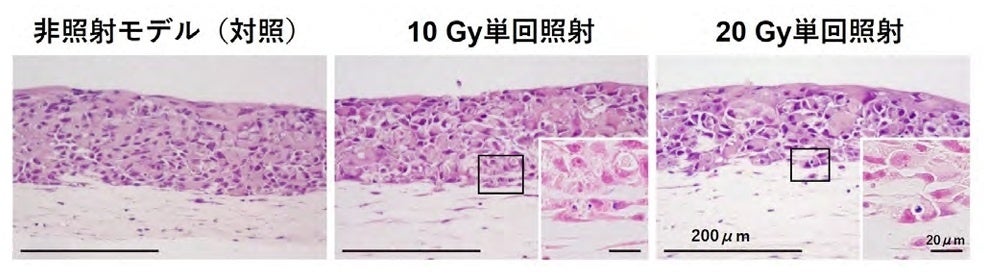 炭素線（10Gy、20Gy）照射後5⽇⽬の3D⼝腔がんモデルの病理組織像。右下挿⼊の⾼ 倍率写真は、照射の影響によるアポトーシス（細胞死）を引き起こした細胞